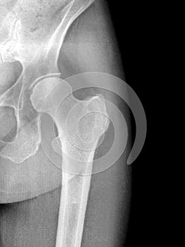X-Ray of an arthritic hip joint in black and white