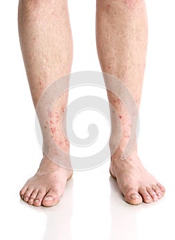 Vertical closeup shot of male feet with red rashes