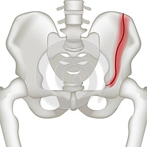 Vertical frature of the human pelvic bone. Realistic rendering for medical design.