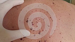 Vertical handheld video of doctor inspecting back of patient with lot of warts nevuses, palpating by hand in a glove.