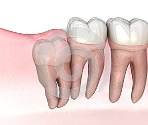 Vertical impaction of Wisdom tooth. Medically accurate tooth 3D illustration