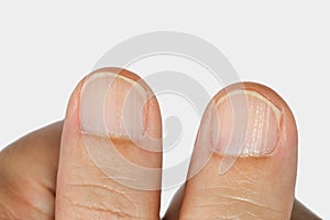 Vertical ridges on the fingernails photo