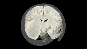 Vertical section through cerebral hemispheres