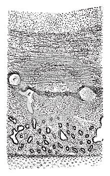 Vertical section through the pseudomembrane, vintage engraving