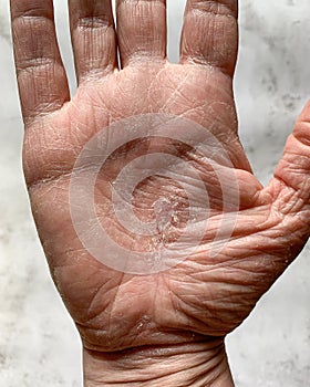 Vertical shot of a hand with a dry cracked skin