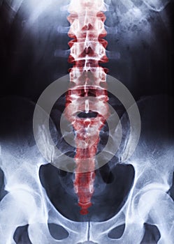 Vertical shot of thespine and pelvis of a human body on x-ray