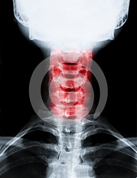 Vertical shot of an X-ray image of the neck and cervical spine