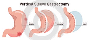 Vertical sleeve gastrectomy. Distended stomach surgery, gastroenterology