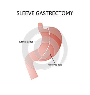 Vertical Sleeve Gastrectomy. Human stomach anatomy isolated on white background. decrease in stomach volume. vector photo