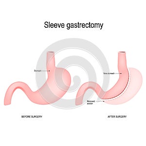 Vertical sleeve gastrectomy photo