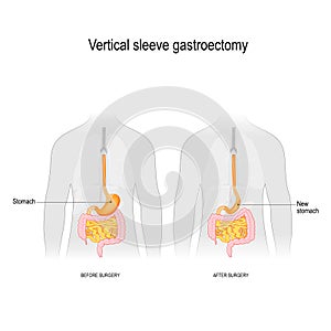 Vertical sleeve gastroectomy. before and after surgery. weight loss surgery