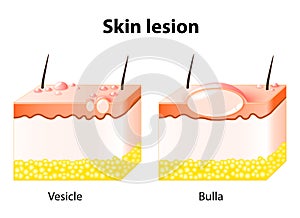 Vesicle and Bulla. Skin lesion