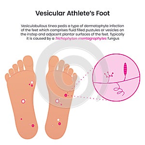 Vesicular Athlete\'s Foot educational vector infographic