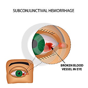 The vessel in the eye burst. Inflammation and redness. The structure of the eye. Infographics. Vector illustration