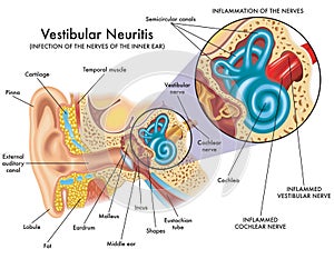 Vestibular neuritis photo