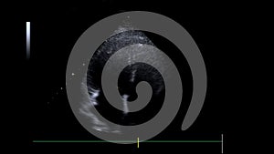 Video echocardiogram or cardiac ultrasound