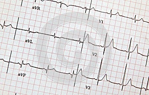 View of ECG or heart beat or health details print out report of patient