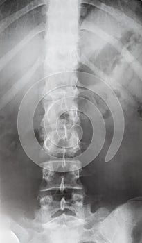 View of human spine in torso on X-ray image