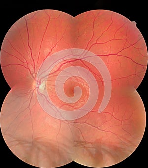View inside human eye disorders showing retina, optic nerve and macula. Retinal picture ,Medical photo tractional eye