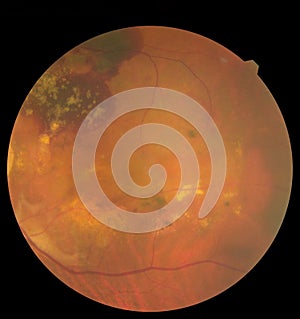 View inside human eye disorders showing retina, optic nerve and macula. Retinal picture ,Medical photo tractional eye