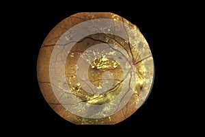 View inside human eye disorders showing retina, optic nerve and macula Severe age-related macular degeneration photo