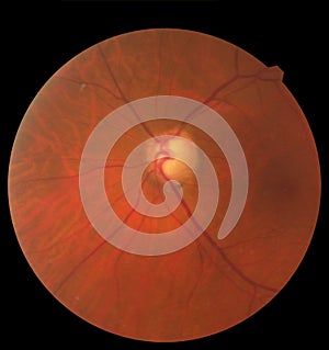 View inside human eye showing retina, optic nerve and macula. Health concept