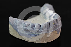 View of plaster model of lower front teeth