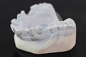 View of plaster model of lower front teeth
