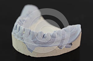 View of plaster model of lower front teeth