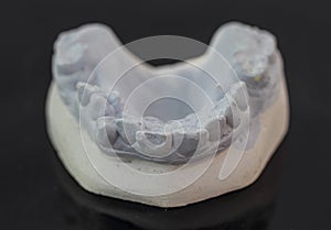 View of plaster model of lower front teeth