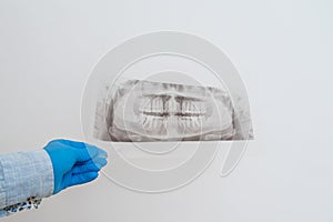 View on radiography of the jaw. Dental x-ray of pacient oral cavity with teeth