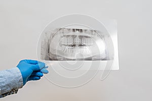 View on radiography of the jaw. Dental x-ray of pacient oral cavity with teeth