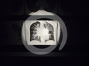 View of the results of computed tomography of the lungs