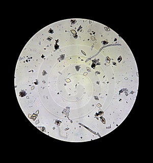 View of the Uric acid in the urine sediment through a microscope. Causes kidney stones photo