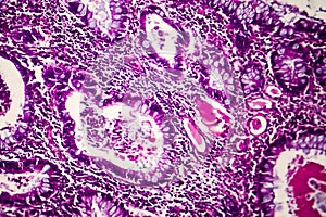Villous colon adenocarcinoma, light micrograph
