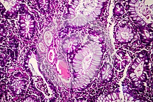 Villous colon adenocarcinoma, light micrograph