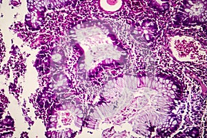 Villous colon adenocarcinoma, light micrograph