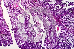 Villous colon adenocarcinoma, light micrograph