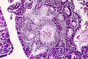 Villous colon adenocarcinoma, light micrograph