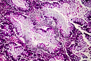 Villous colon adenocarcinoma, light micrograph photo