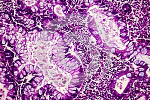Villous colon adenocarcinoma, light micrograph