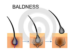 Violation of blood circulation in the hair follicle. baldness photo