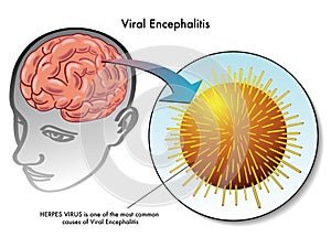 Viral encephalitis