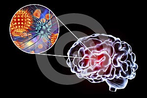 Viral encephalitis illustration