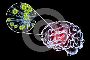 Viral encephalitis illustration