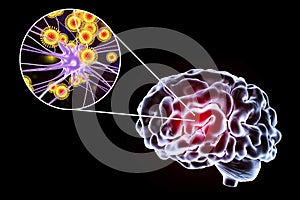 Viral encephalitis illustration