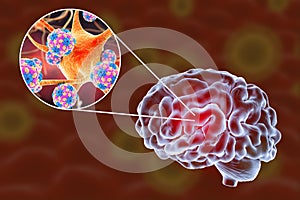 Viral encephalitis illustration