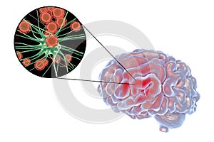 Viral encephalitis illustration