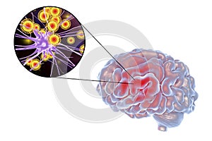 Viral encephalitis illustration