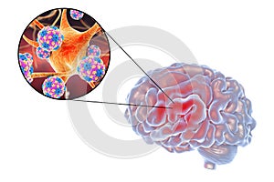 Viral encephalitis illustration